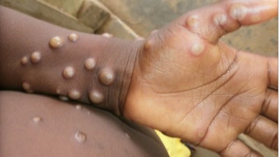 Understanding the Mpox Emergency: Causes, Symptoms, Treatment, and Prevention