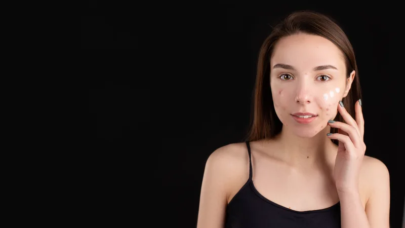 Effective Ways to Treat Hormonal Acne: A Comprehensive Guide