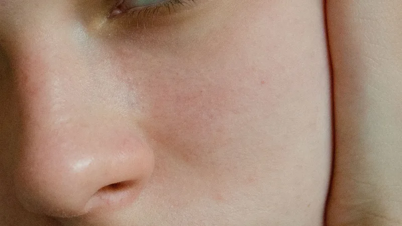 Tranexamic Acid for Skincare: A Comprehensive Guide