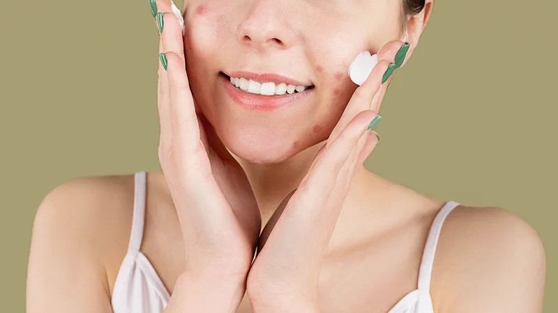 The Dos and Don'ts of Treating Acne: Expert Advice