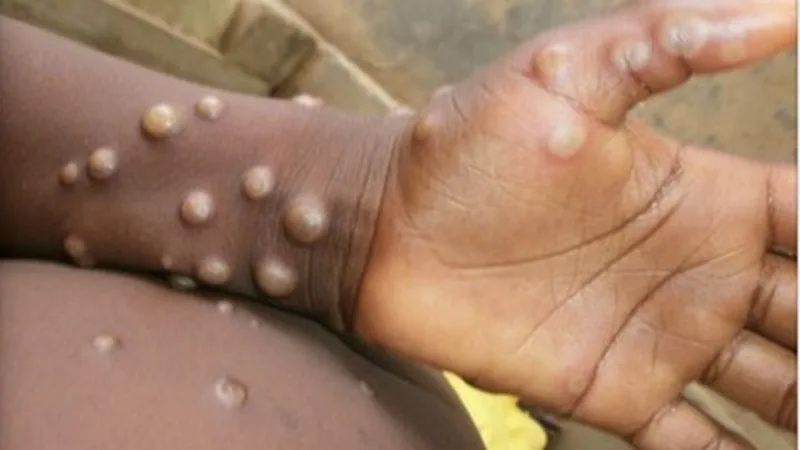Understanding the Mpox Emergency: Causes, Symptoms, Treatment, and Prevention